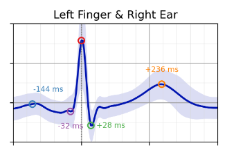 Pulse Wave from Finger-to-Ear-ECG